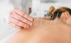 back acupuncture