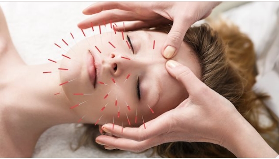 acupuncture